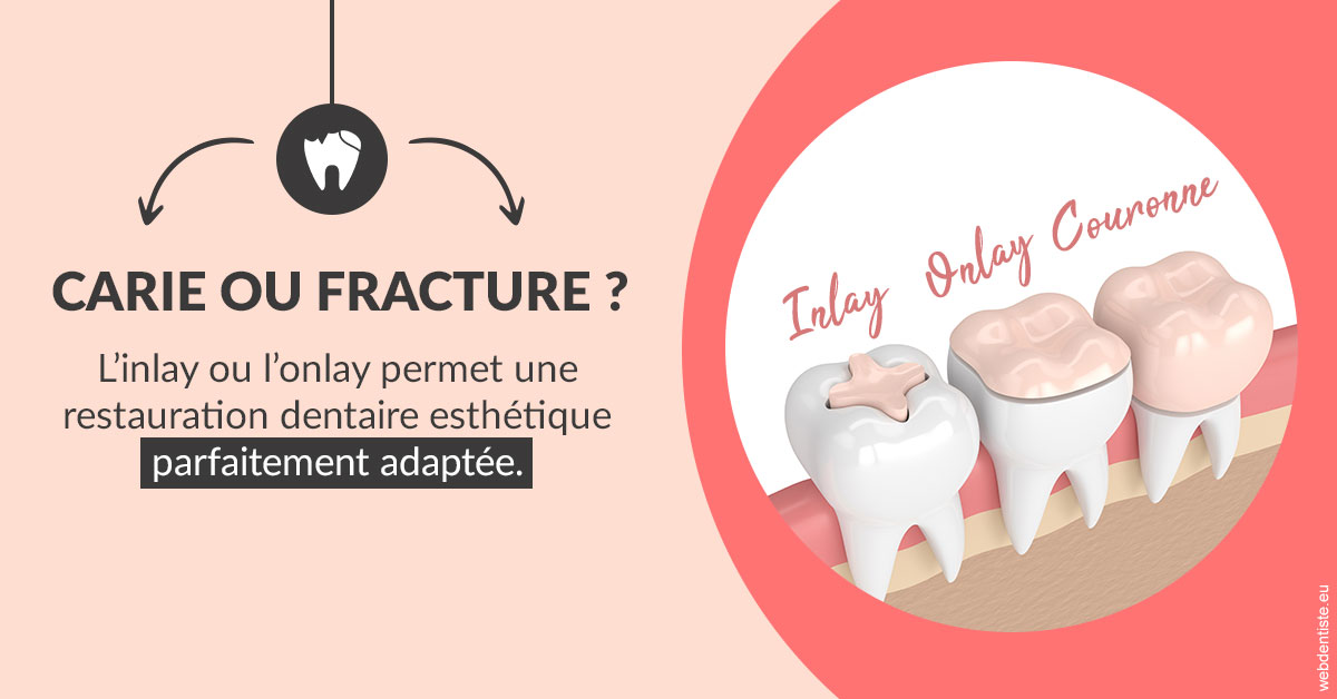 https://dr-cousin-julien.chirurgiens-dentistes.fr/T2 2023 - Carie ou fracture 2