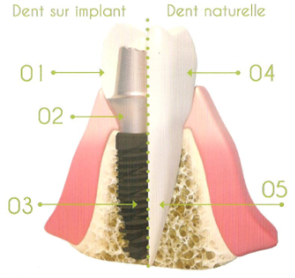 Implantologie  - Lille - Nord