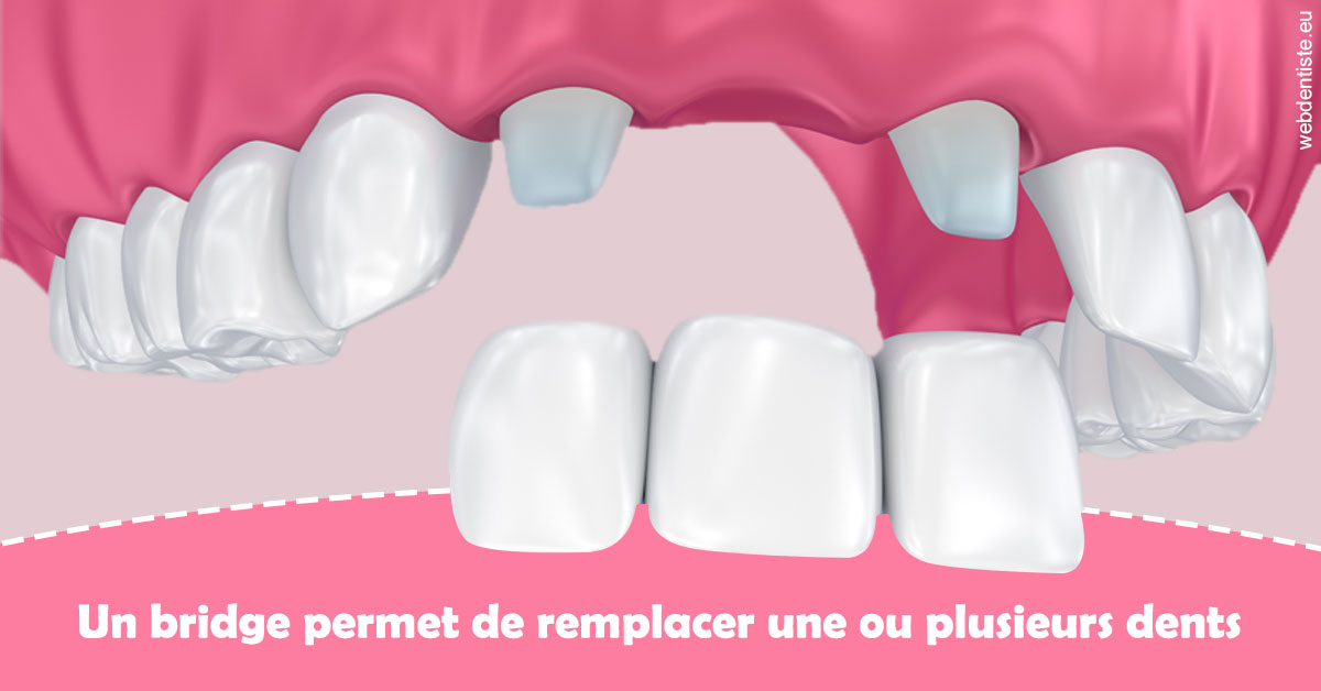 https://dr-cousin-julien.chirurgiens-dentistes.fr/Bridge remplacer dents 2