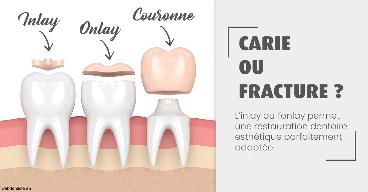 https://dr-cousin-julien.chirurgiens-dentistes.fr/T2 2023 - Carie ou fracture 1