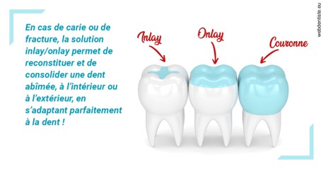 https://dr-cousin-julien.chirurgiens-dentistes.fr/L'INLAY ou l'ONLAY