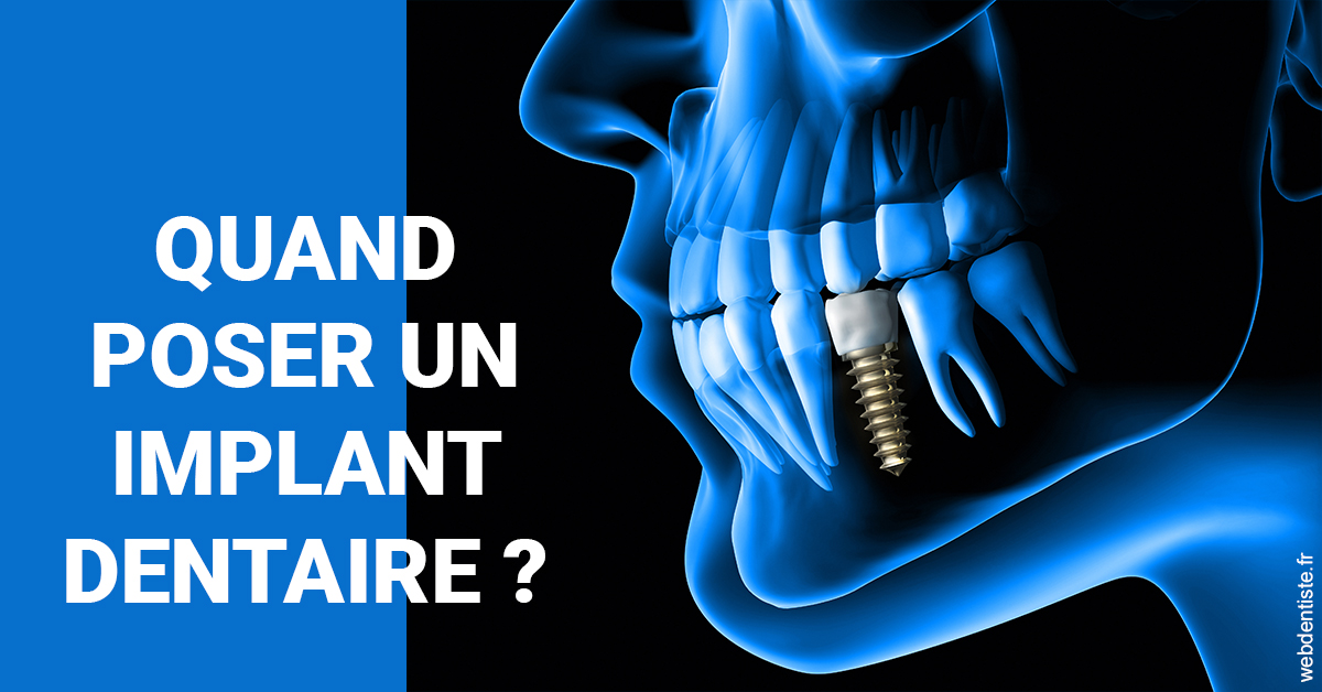 https://dr-cousin-julien.chirurgiens-dentistes.fr/Les implants 1