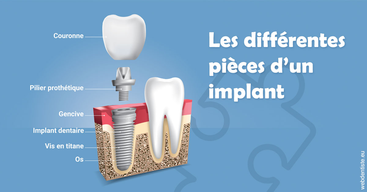 https://dr-cousin-julien.chirurgiens-dentistes.fr/Les différentes pièces d’un implant 1